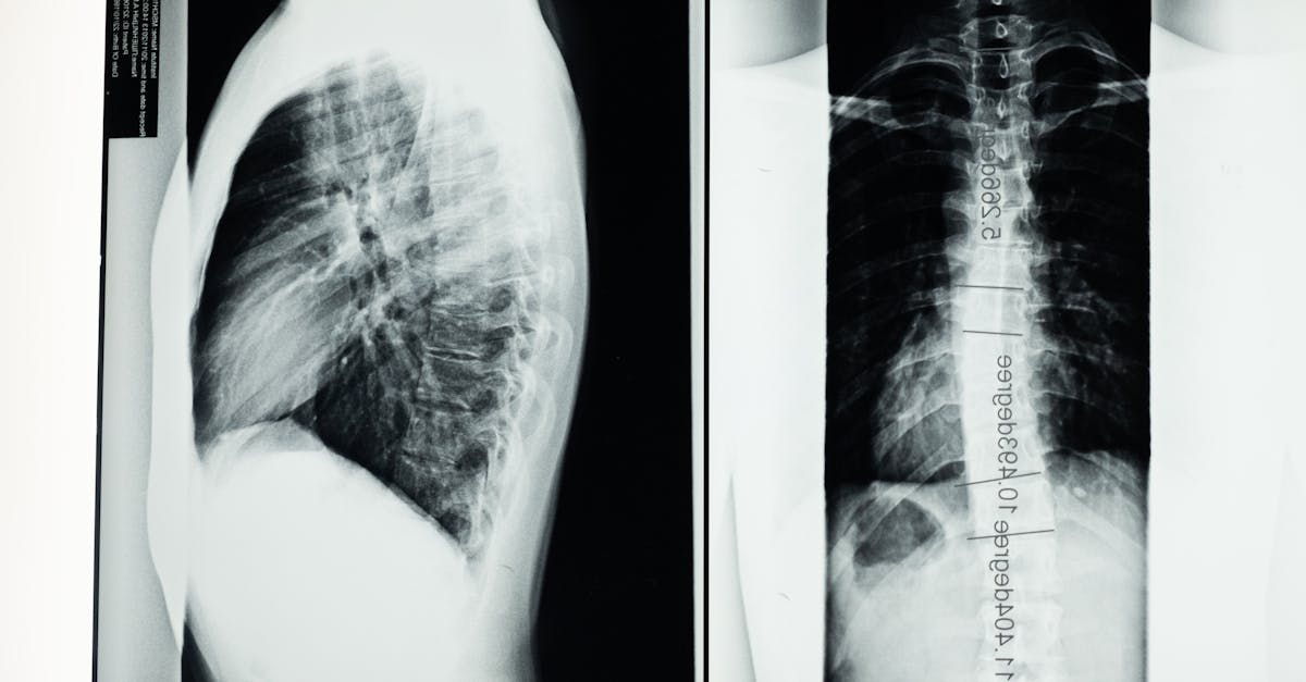 discover everything you need to know about scoliosis, including its causes, symptoms, and treatment options. learn how to manage this condition effectively and improve your quality of life.