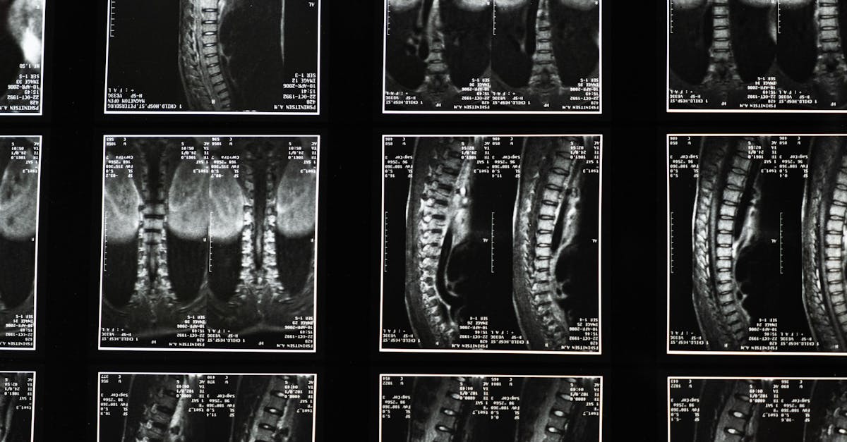 Descubra información esencial sobre la escoliosis, una enfermedad caracterizada por una curvatura anormal de la columna. Conozca las causas, los síntomas, las opciones de tratamiento y cómo controlar esta afección para tener una vida más saludable.