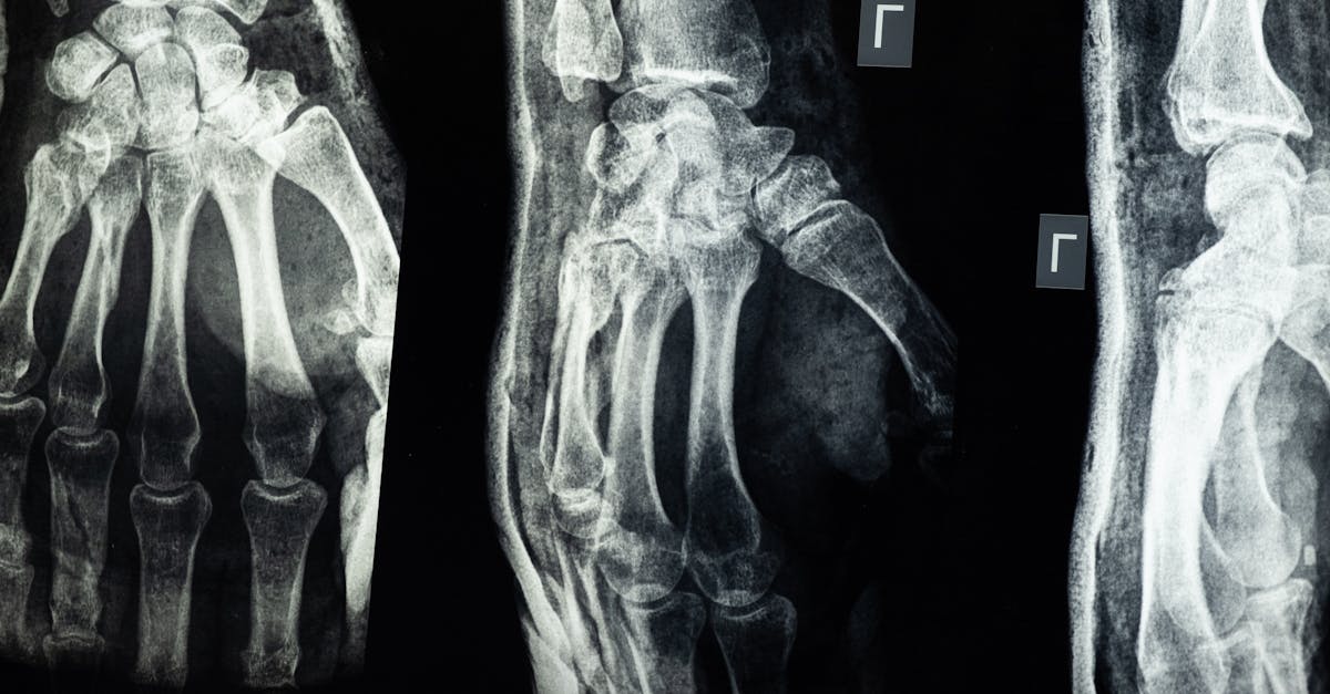 Rotator Cuff Injury Concerns? Trust Pulse Align’s Supportive Routines 4 learn about rotator cuff injury, including common symptoms, causes, treatment options, and recovery tips to help you manage shoulder pain and restore mobility.